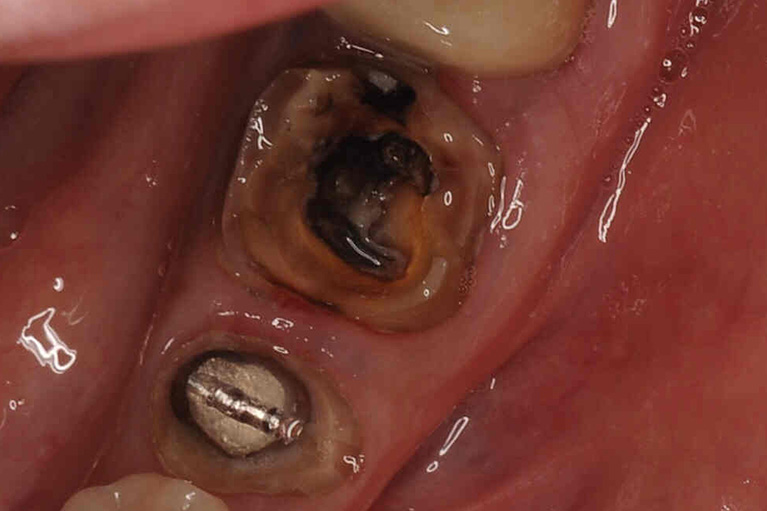 被せ物の中でむし歯ができているので被せ物を外します むし歯で感染している状態です(暗い部分)